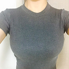 韩国来福琳胸部整形真实案例